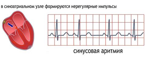 Симптомы синусовой аритмии эос горизонтальной