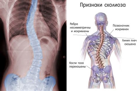 Симптомы сколиоза с ротацией позвонков