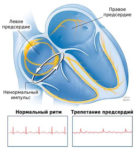 Симптомы трепетания предсердий