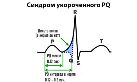 Симптомы укороченного интервала pq