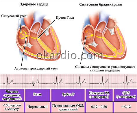 Симптомы умеренной брадикардии у детей