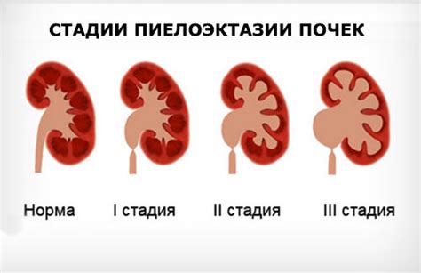 Симптомы умеренной пиелоэктазии