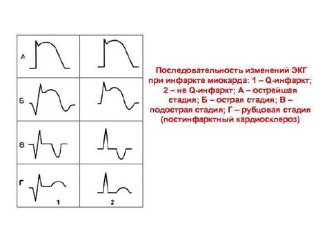 Симптомы умеренных диффузных изменений ЭКГ