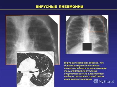 Симптомы усиленного сосудистого рисунка легких