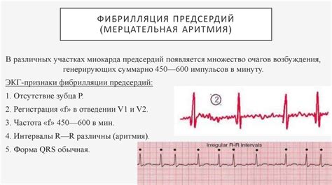 Симптомы фибрилляции предсердий тахисистолической формы