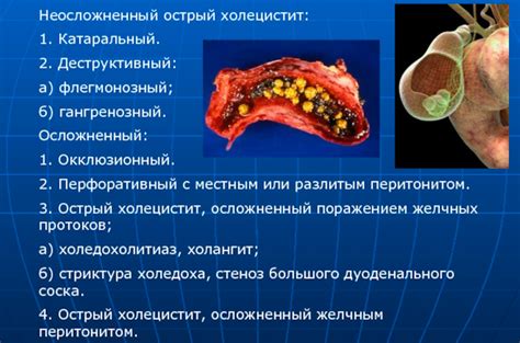 Симптомы флегмонозного калькулезного холецистита