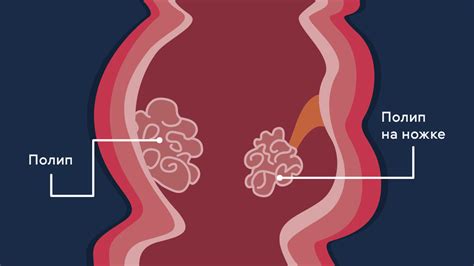 Симптомы формирующихся полипов