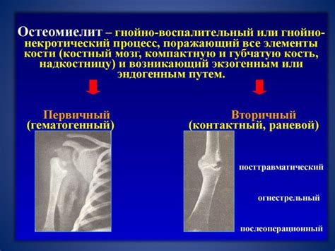 Симптомы хронического остеомиелита: