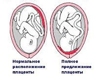 Симптомы центрального предлежания