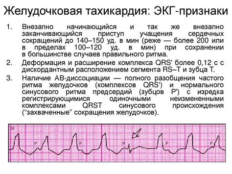 Симптомы частой желудочковой экстрасистолии