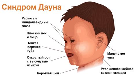 Синдром Дауна: основные аспекты и определение