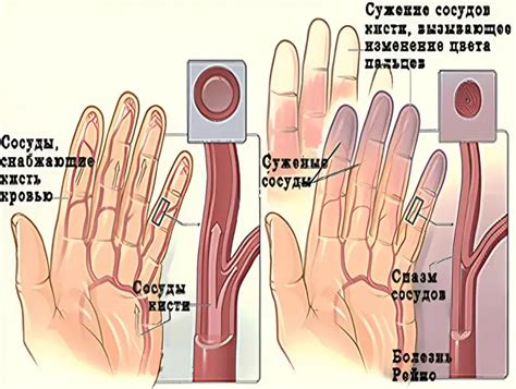 Синдром Рейно: первичные признаки и симптомы