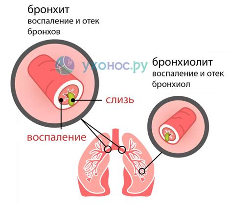 Синдром респираторной бронхиолита у новорожденных: причины, симптомы и лечение