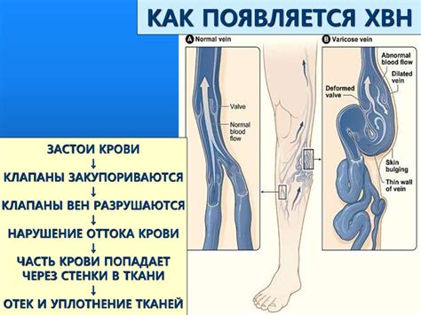 Синдром хронической венозной недостаточности