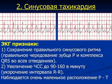 Синусовая брадикардия: определение и характеристики