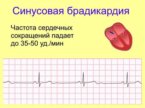 Синусовая брадикардия с синусовой аритмией