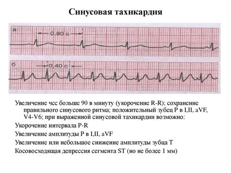 Синусовая брадикардия у ребенка: какие могут быть последствия?