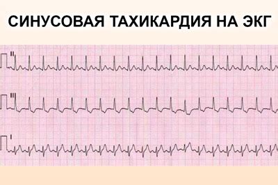 Синусовая тахикардия у мужчин