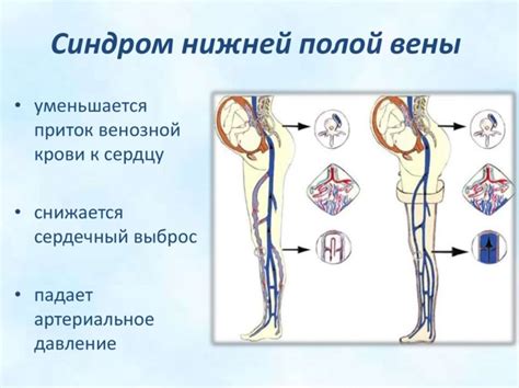 Склеротерапия при коллапсе нижней полой вены