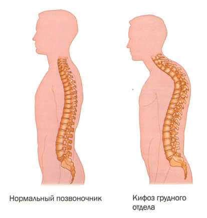 Сколиоз и другие проблемы позвоночника, вызывающие боль в груди