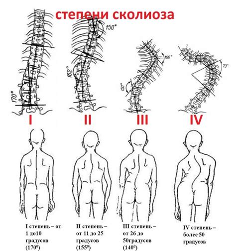 Сколиоз позвоночника