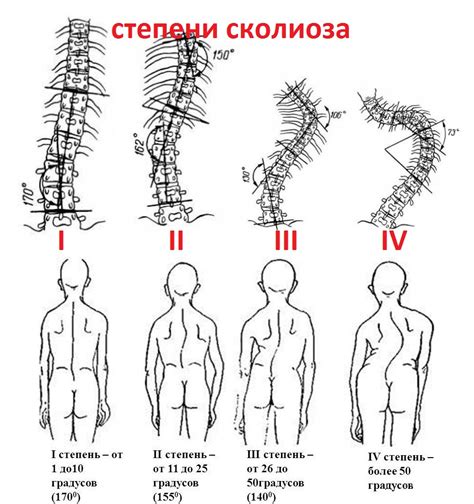 Сколиотическая осанка у ребенка: причины, признаки и лечение