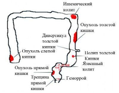 Скрытая кровь в кале: возможные причины и методы диагностики