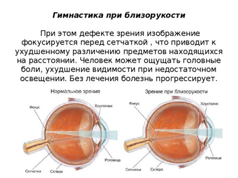 Слабость зрения при недостаточном освещении