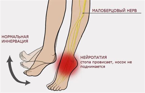 Слабость и неустойчивость при ходьбе