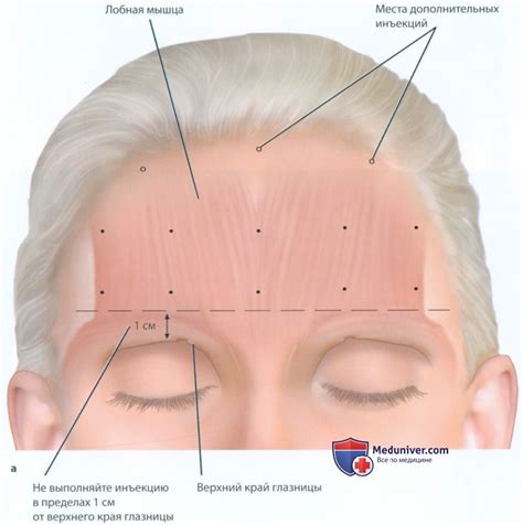 Слабость мышц лба после инъекции