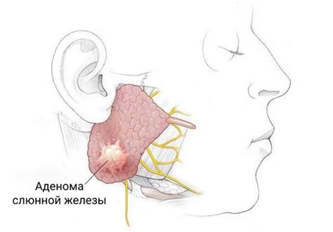 Смешанная опухоль околоушной слюнной железы: симптомы, диагностика, лечение