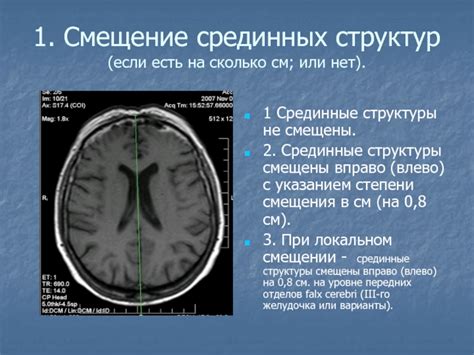 Смещение вправо срединных структур головного мозга: причины и последствия