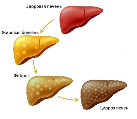 Снижение риска развития цирроза печени