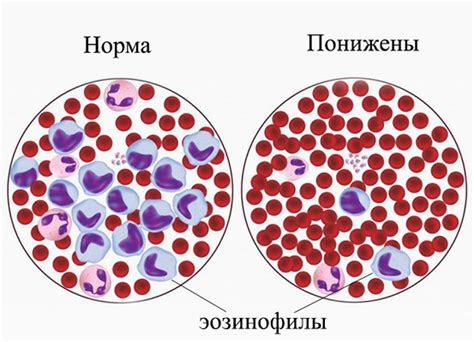 Снижение эозинофилов