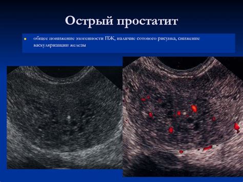 Снижение эхогенности предстательной железы