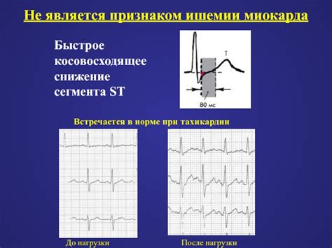 Снижение ST при ишемии миокарда