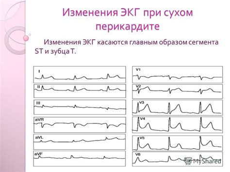 Снижение ST при перикардите и миокарде