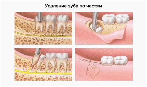 Соберите и сохраните осколок зуба