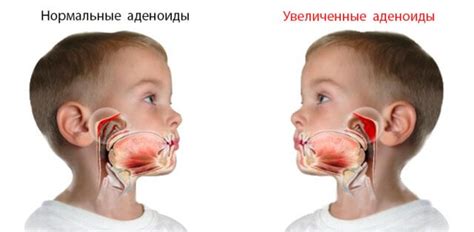 Советы по профилактике аденоидов 2 степени