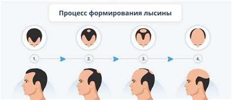 Современные методы борьбы с лысиной