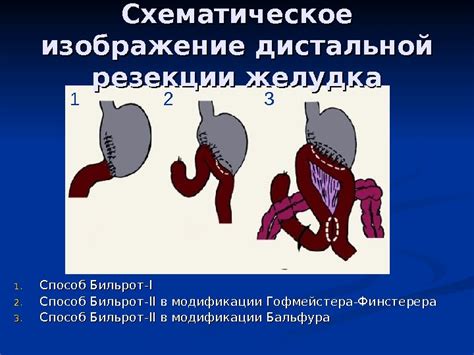 Современные методы лечения метаплазии желудка