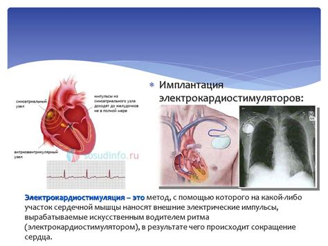 Современные методы лечения нарушения проводимости сердца у детей