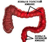 Современные методы лечения неспецифического язвенного колита