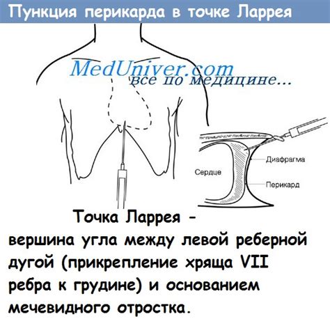 Современные методы лечения перикардиального выпота