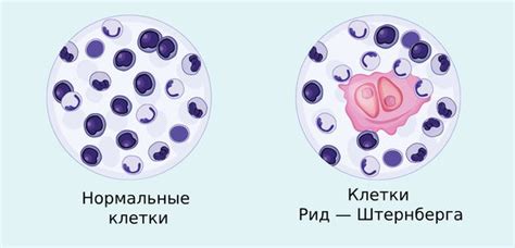 Современные методы лечения полной ремиссии при лимфоме Ходжкина