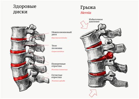 Современные технологии при лечении грыжи