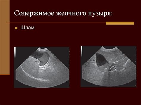 Содержимое желчного пузыря эхонегативное: диагностика