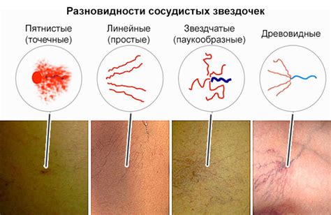 Сосудистые локусы: причины и симптомы