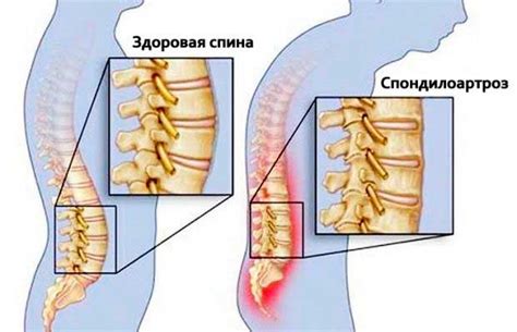 Спондилоартроз: что это значит, симптомы и лечение