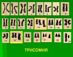 Способы диагностики трисомии 21